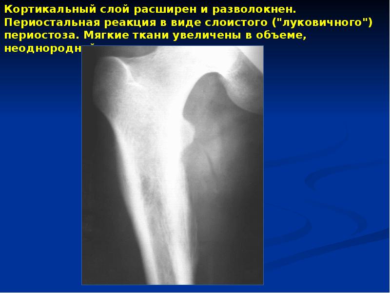 Саркомы мягких тканей презентация