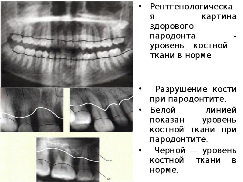 Пародонтит рентгенологическая картина