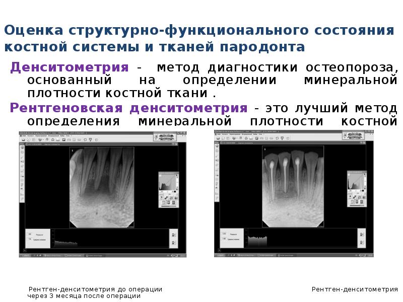 Оценка пародонта. Рентген денситометрия костной плотности. Рентген на плотность костной ткани. УЗИ плотности костной ткани. Денситометрия для оценки минеральной плотности костной ткани.