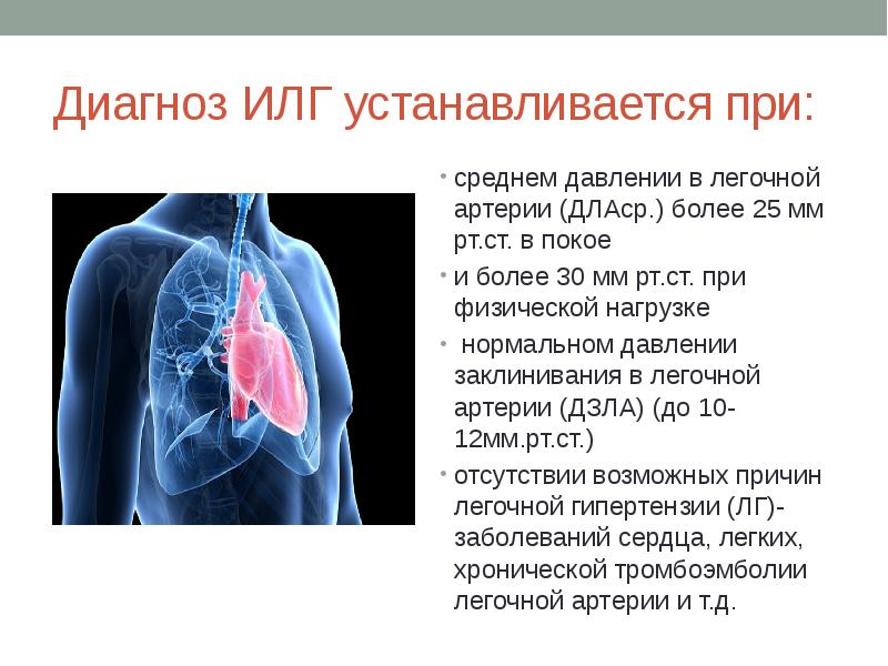 Легочная артериальная гипертензия презентация