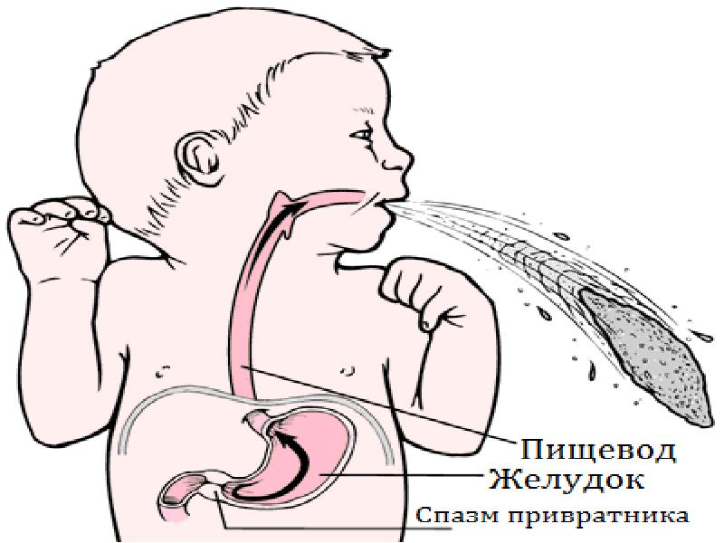 Пилороспазм у детей презентация