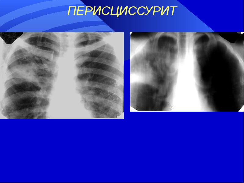 Перисциссурит рентген картина