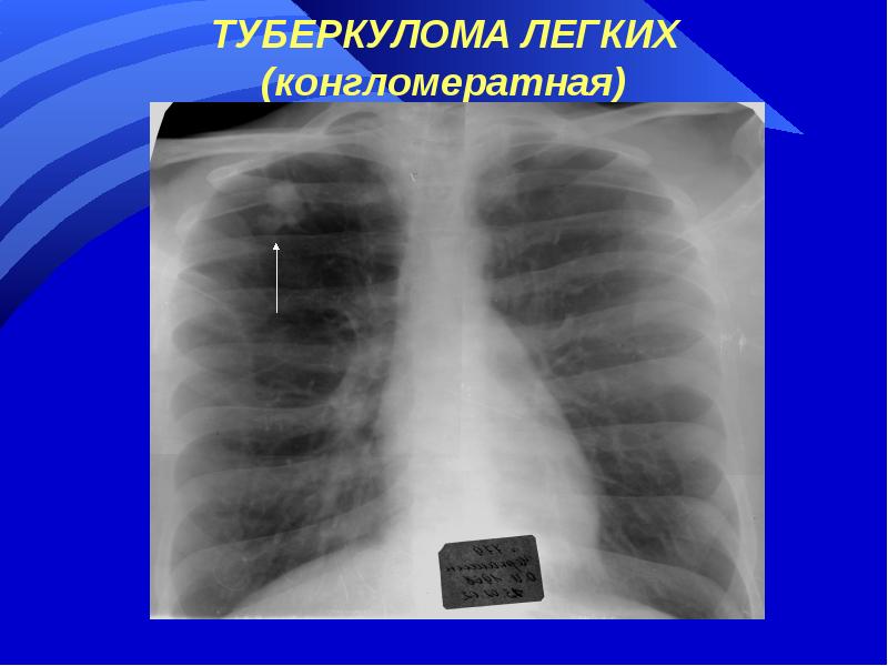 Укажите характерную аускультативную картину для туберкулемы легких