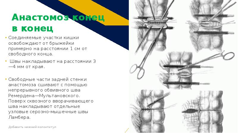 Анастомоз конец в конец схема