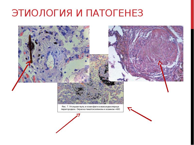 Этиология и патогенез