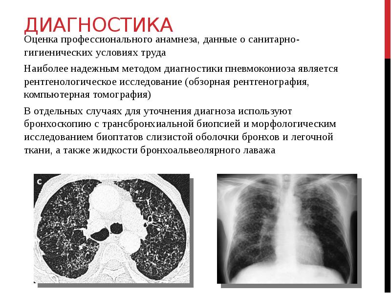 Диагностика Оценка профессионального анамнеза, данные о санитарно-гигиенических условиях труда Наиболее надежным