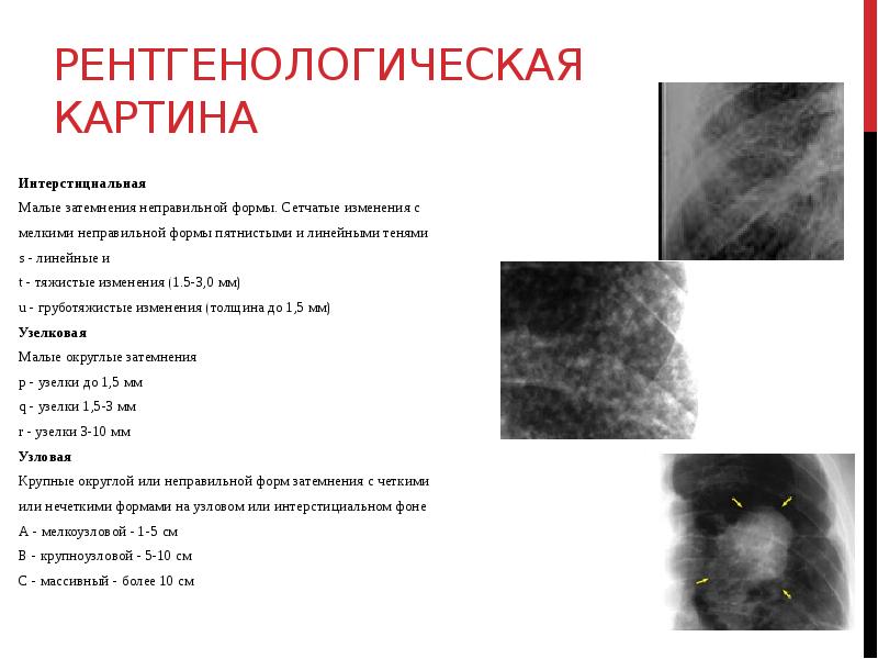 Характерная морфологическая картина легочной ткани при пневмокониозах включает изменения в виде