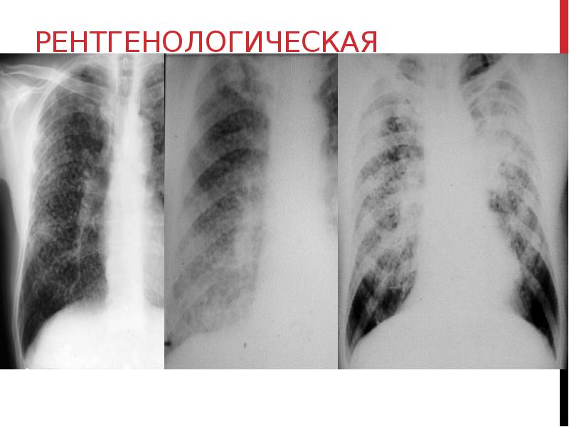 Рентгенологическая классификация I стадия-интерстициальные изменения (ячеистый и линейный легочный рисунок), или