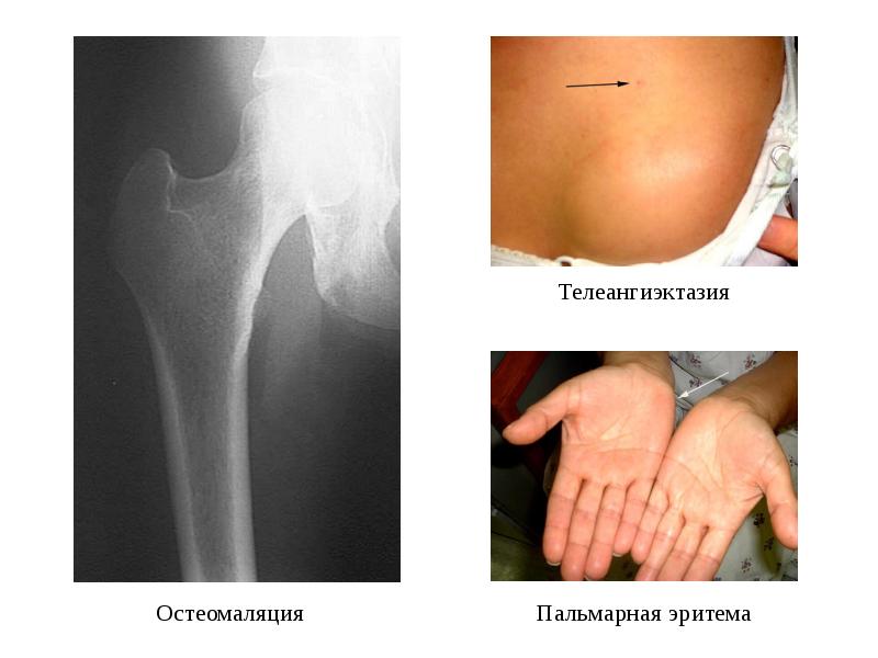 Пальмарная эритема это печени фото Хроническая печеночная недостаточность. Смешанная форма