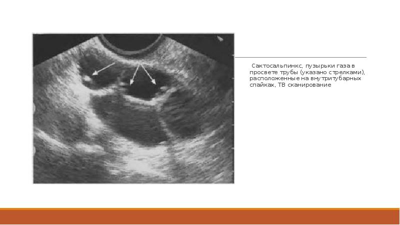 Сактосальпинкс на узи фото