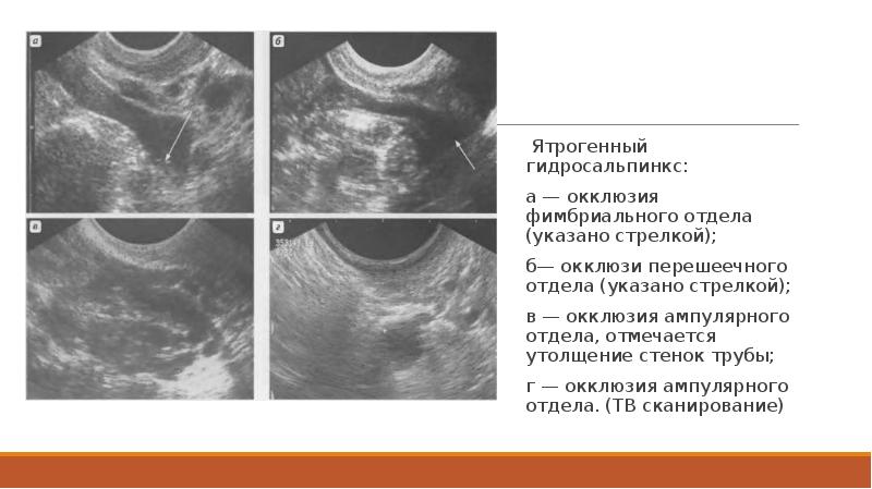 Сактосальпинкс на узи фото