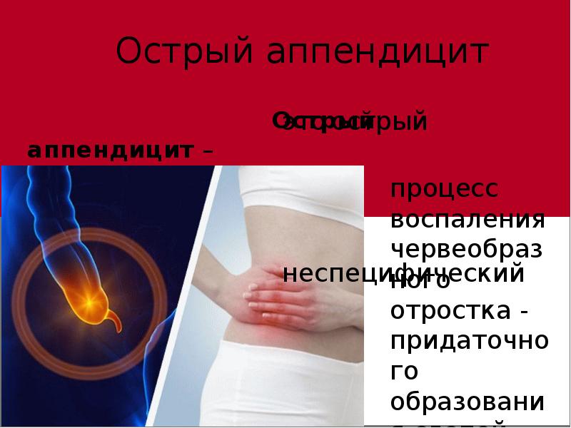 В какой стороне аппендицит у взрослых. Аппендицит презентация.