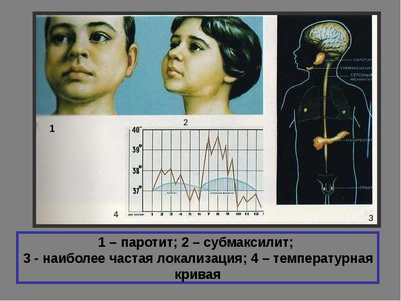 Паротиты у детей презентация