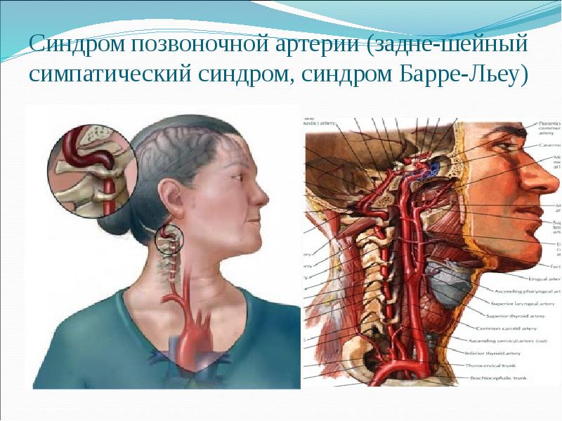 Шейная позвоночная артерия. Синдром позвоночной артерии шейная мигрень. Задний шейный симпатический синдром (синдром позвоночной артерии).. Шейная мигрень задний шейный симпатический синдром Барре. Синдром позвоночной артерии (синдром Унтерхарншейдта).