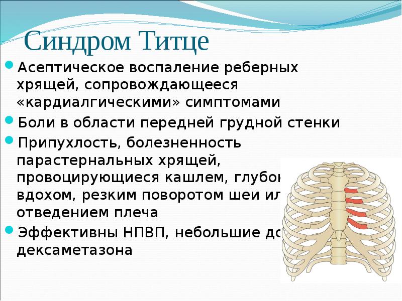 Титце синдром у детей фото