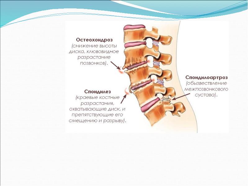 Дегенеративно дистрофические изменения шейного отдела позвоночника. Деформирующий спондилез поясничного отдела l1 s1. Деформирующий спондилез l2 l5. Остеохондроз спондилоартроз поясничного отдела позвоночника. Остеохондроз и спондилоартроз позвоночника.