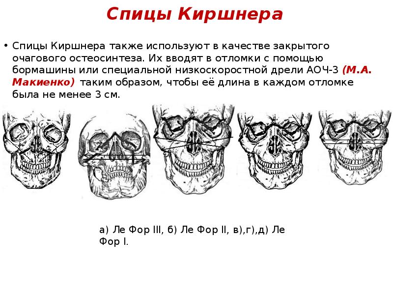 Переломы челюстей презентация