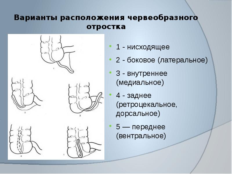 Варианты расположения червеобразного отростка схема