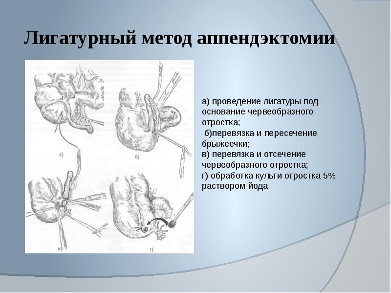 Карта вызова аппендицит у взрослого