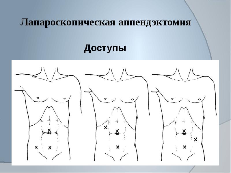 Острый аппендицит у детей презентация