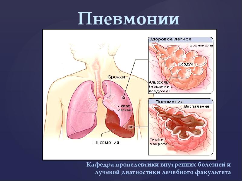 Пневмония у детей картинки для презентации - 82 фото