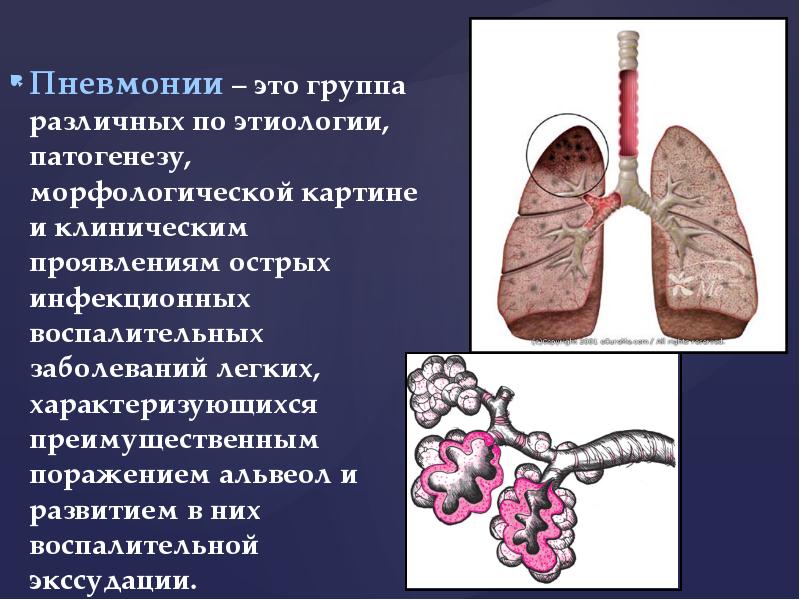 Пневмония это инфекционное заболевание. Воспаление легких презентация. Пневмония презентация. Пневмония внутренние болезни презентация. Инфекционные заболевания легких.