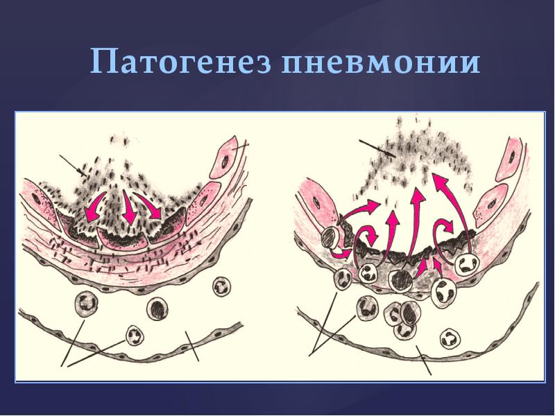 Патогенез пневмонии схема