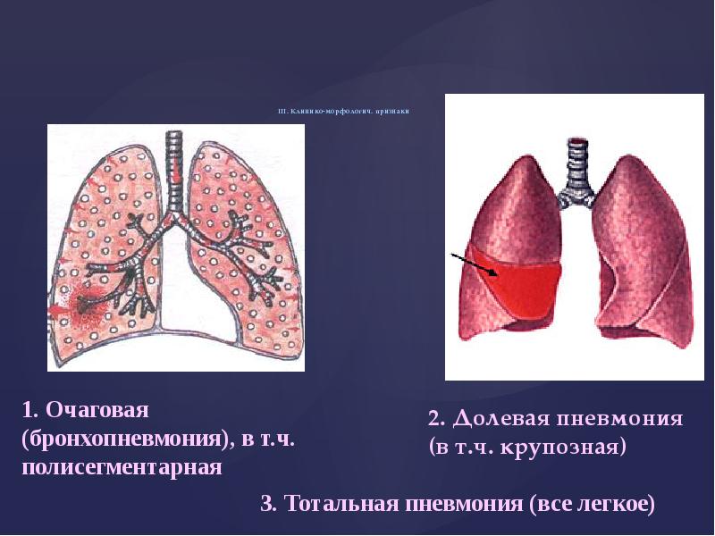 Пневмонии клиническая картина очаговой и крупозной пневмонии