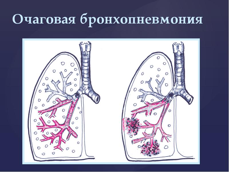 Аурухана ішілік пневмония презентация