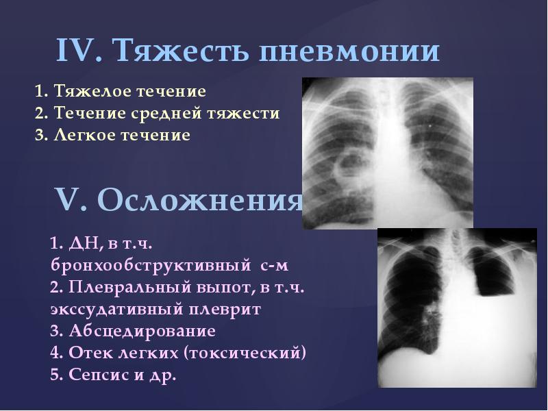 Пневмония презентация внутренние болезни