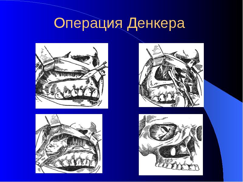 Резекция верхней челюсти презентация