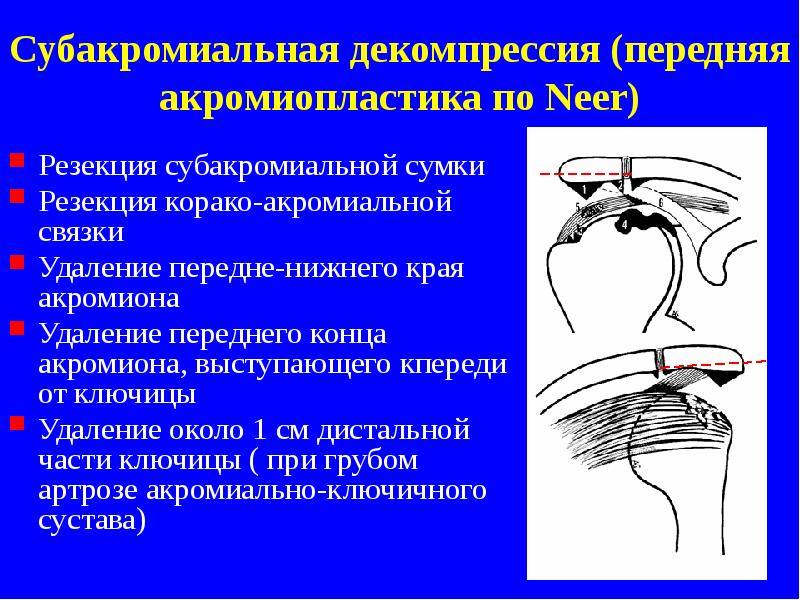 Субакромиальная декомпрессия (передняя акромиопластика по Neer)
Резекция субакромиальной сумки
Резекция корако-акромиальной Субакромиальная декомпрессия (передняя акромиопластика по Neer)
Резекция субакромиальной сумки
Резекция корако-акромиальной