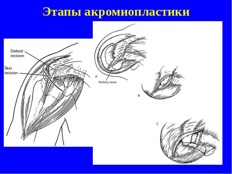 Этапы акромиопластики Этапы акромиопластики