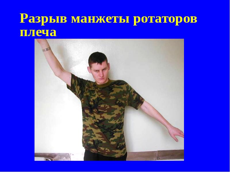 Разрыв манжеты ротаторов плеча Разрыв манжеты ротаторов плеча