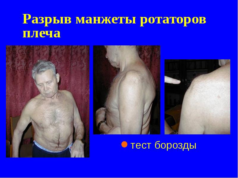 Разрыв манжеты ротаторов плеча Разрыв манжеты ротаторов плеча