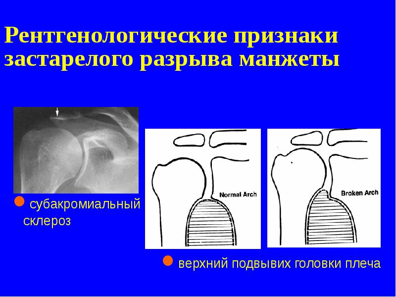 Рентгенологические признаки застарелого разрыва манжеты Рентгенологические признаки застарелого разрыва манжеты