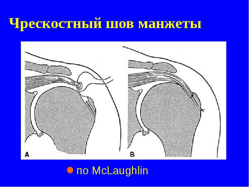 Чрескостный шов манжеты Чрескостный шов манжеты
