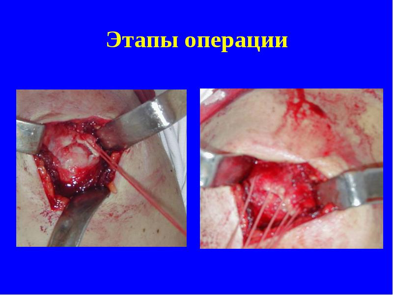 Этапы операции Этапы операции