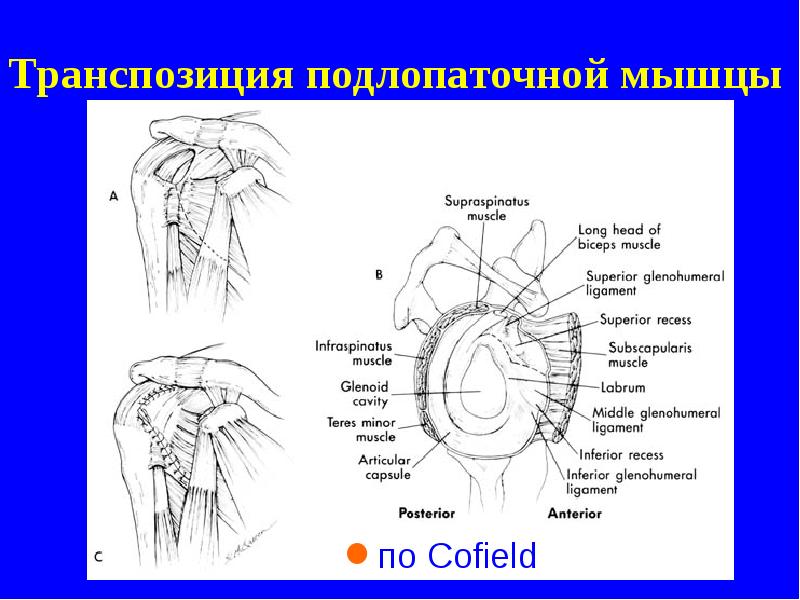 Транспозиция подлопаточной мышцы Транспозиция подлопаточной мышцы