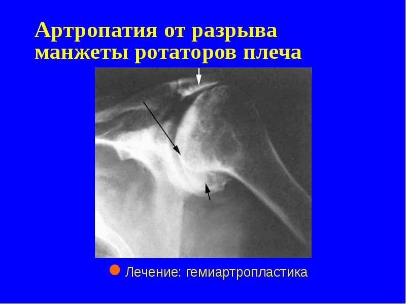 Артропатия от разрыва манжеты ротаторов плеча Артропатия от разрыва манжеты ротаторов плеча