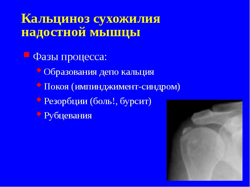 Кальциноз сухожилия надостной мышцы
Фазы процесса:
Образования депо кальция
Покоя (импинджимент-синдром)
Кальциноз сухожилия надостной мышцы
Фазы процесса:
Образования депо кальция
Покоя (импинджимент-синдром)