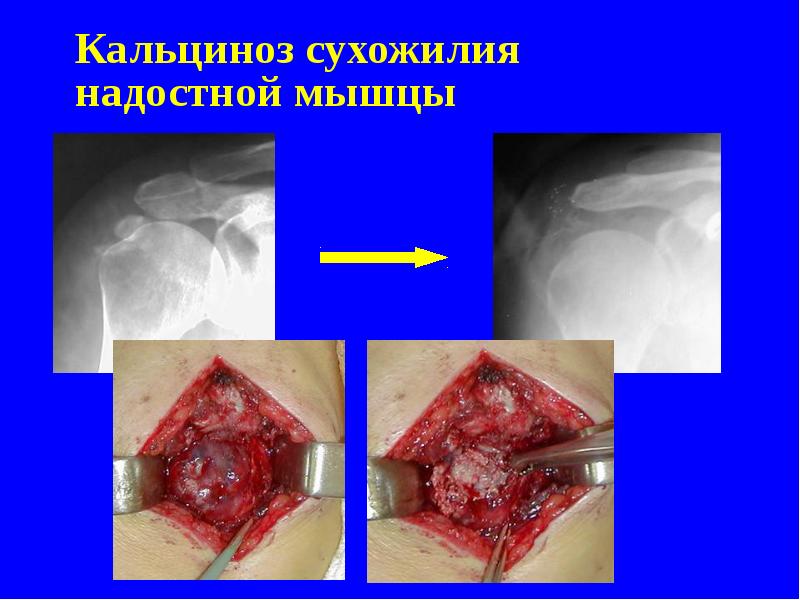 Кальциноз сухожилия надостной мышцы