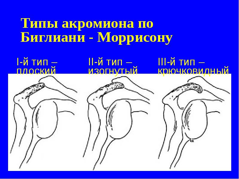 Типы акромиона по Биглиани - Mоррисону Типы акромиона по Биглиани - Mоррисону