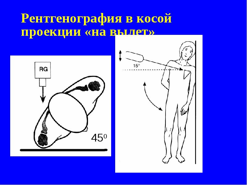 Рентгенография в косой проекции «на вылет» Рентгенография в косой проекции «на вылет»