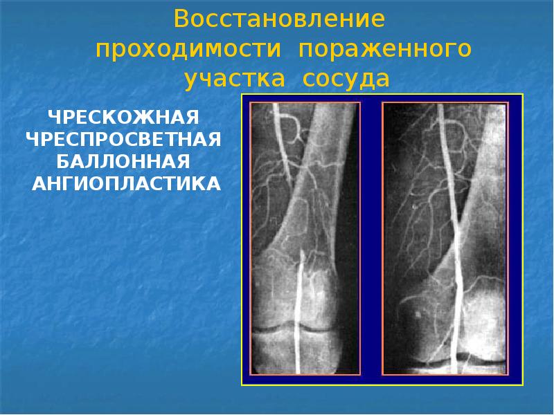 Чрескожная ангиопластика. Баллонная ангиопластика артерий нижних конечностей. Восстановление проходимости сосуда. Чрескожная баллонная ангиопластика. Экстраанатомическое шунтирование.