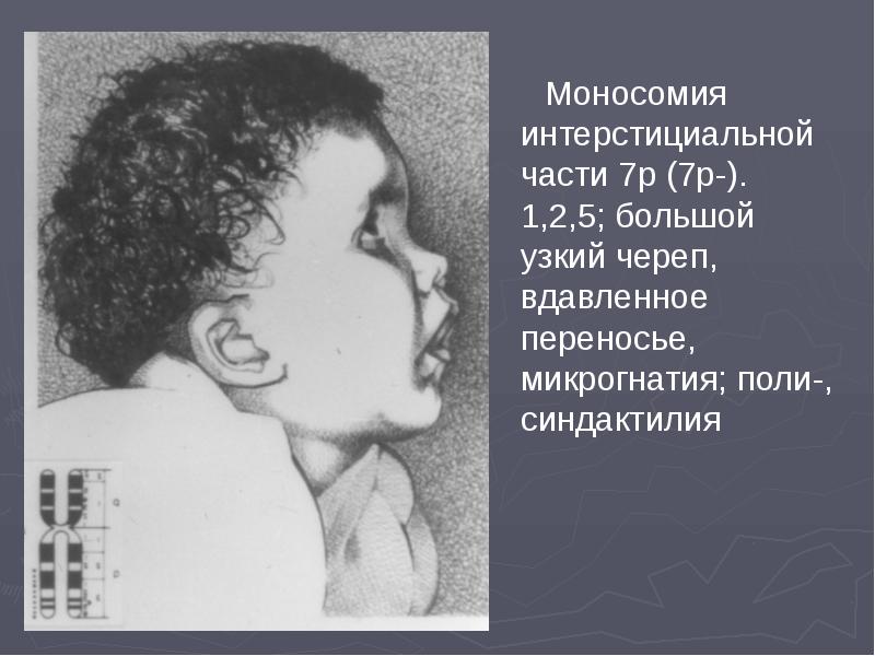 Моносомия интерстициальной части 7р (7р-). 1,2,5; большой узкий череп, вдавленное переносье,
