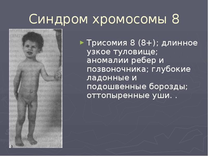 Синдром хромосомы 8 Трисомия 8 (8+); длинное узкое туловище; аномалии ребер