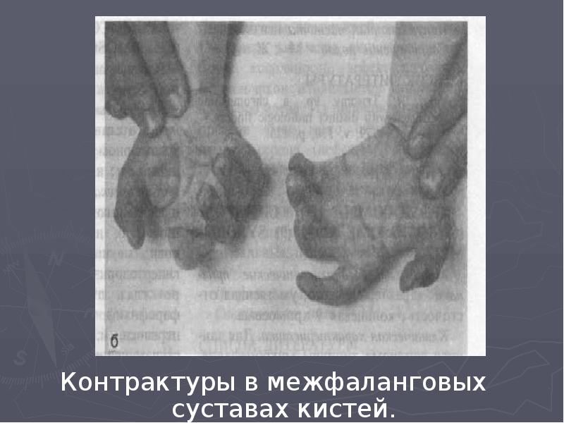 Контрактуры в межфаланговых суставах кистей. Контрактуры в межфаланговых суставах кистей.