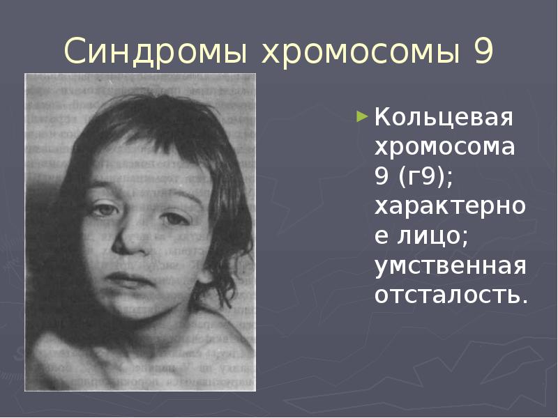 Синдромы хромосомы 9 Кольцевая хромосома 9 (г9); характерное лицо; умственная отсталость.