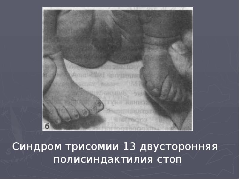 Синдром трисомии 13 двусторонняя полисиндактилия стоп  Синдром трисомии 13 двусторонняя